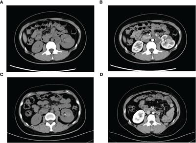 A safe and effective treatment combination of neoadjuvant therapy and surgical resection for metastatic TFE3-rearranged renal cell carcinoma:a case report